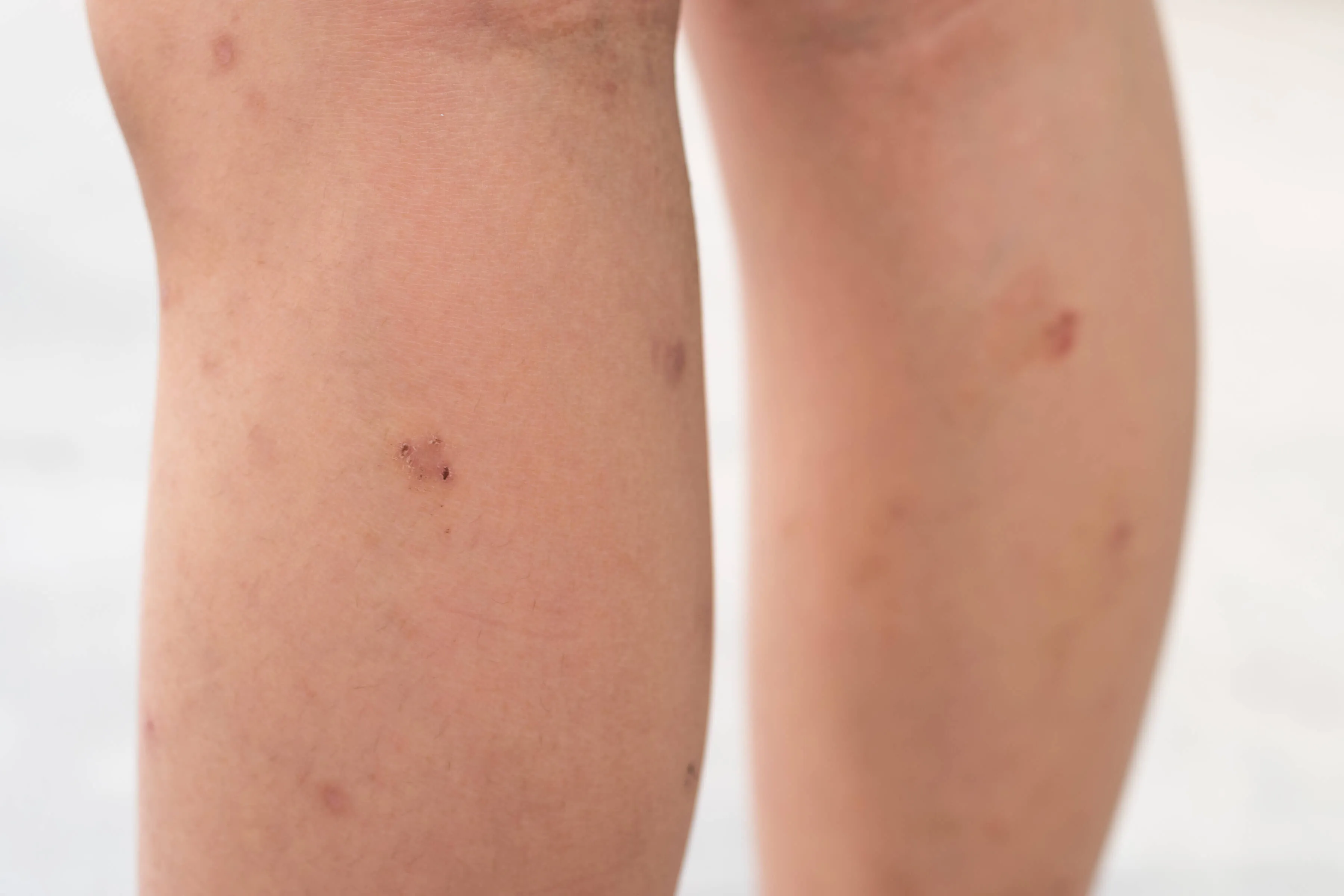 Close-up of a person's legs with multiple skin blemishes, scars, and small wounds.