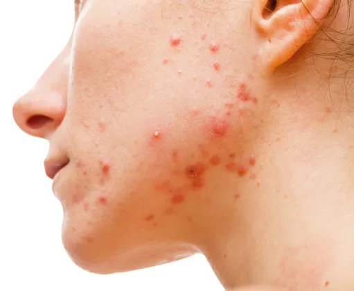 A close-up of a woman's face with severe acne, showing inflamed red pimples and pustules on her cheek and jawline.
