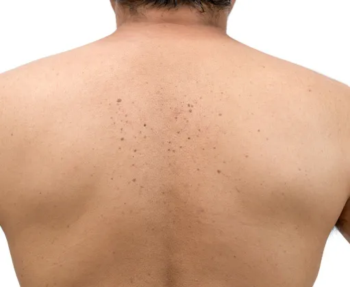 Back acne treatment for clearer skin at a dermatology clinic. Expert solutions for acne scars, breakouts, and skin health.