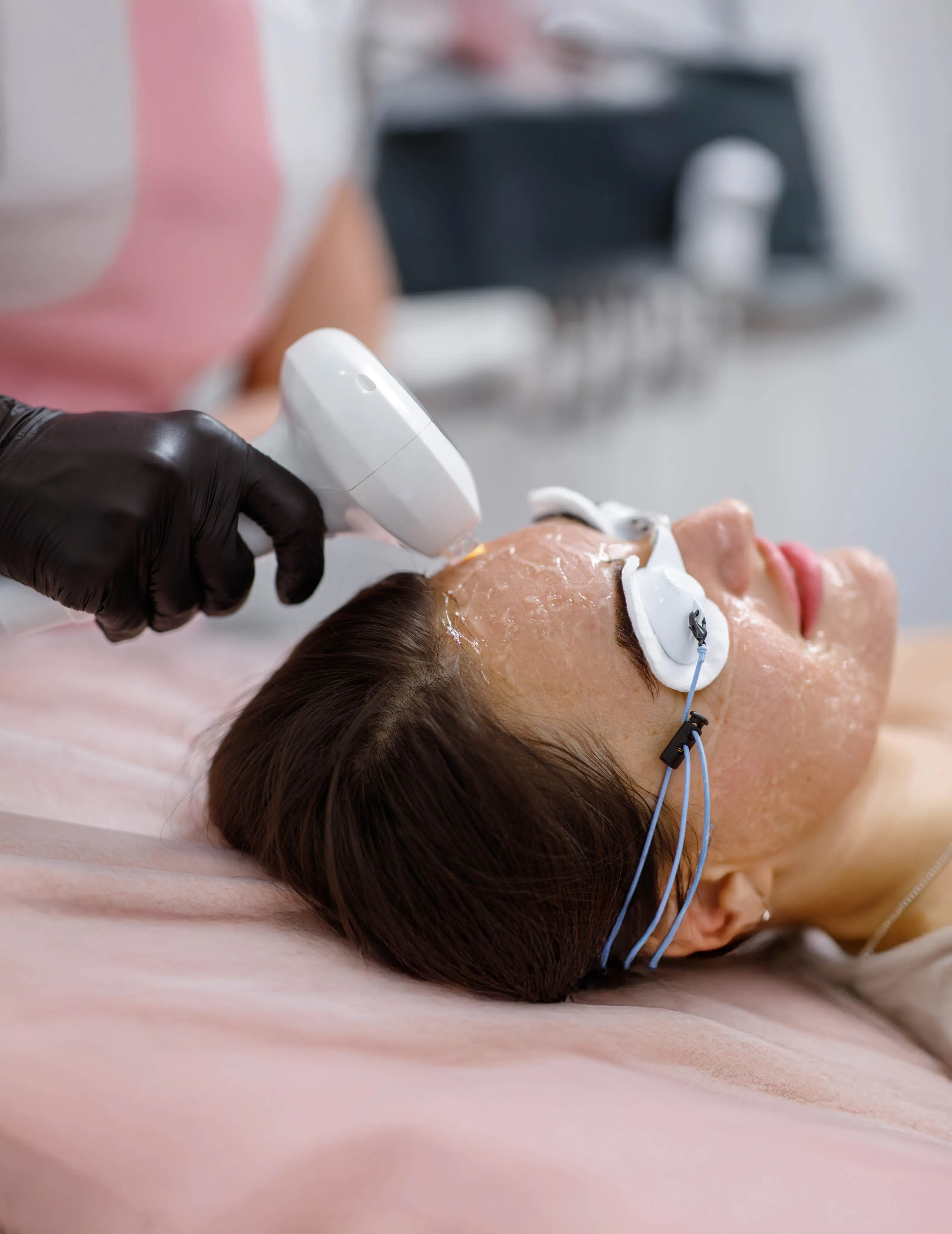 IPL photofacial treatment at a dermatology clinic. Rejuvenate skin, reduce pigmentation, and improve texture with laser therapy.