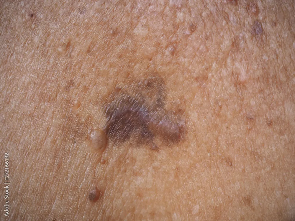 Close-up of an irregular dark mole, a possible sign of melanoma, requiring dermatology evaluation for skin cancer detection.