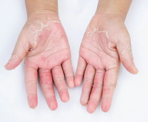 Close-up of hands with peeling, irritated skin, possibly due to eczema or dermatitis, treated by dermatology specialists.