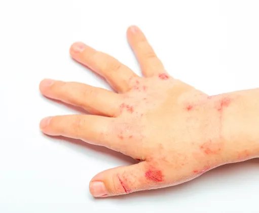Child's hand with red, inflamed eczema or dermatitis, requiring professional dermatology treatment for relief and healing.