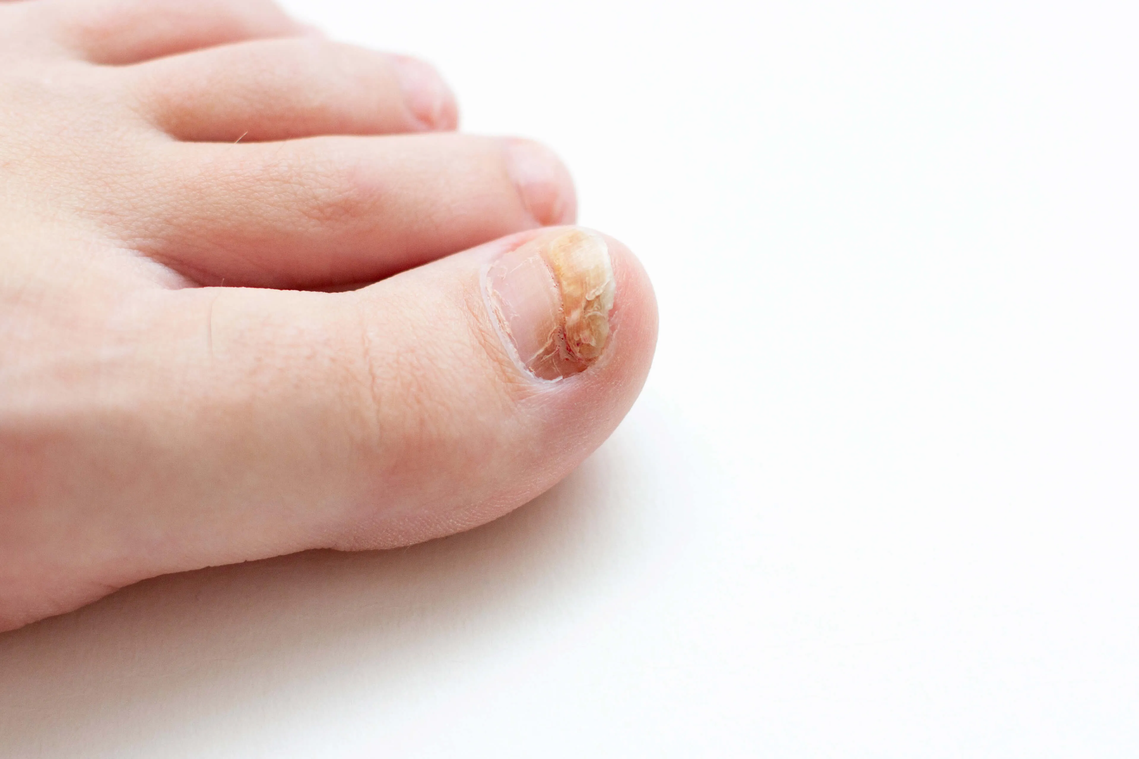 Close-up of a toenail with a fungal infection, showing discoloration, thickening, and brittleness.