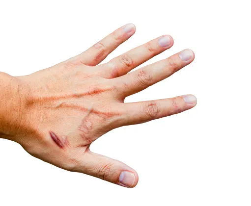 Hand with scars and healing wounds, treatable with dermatology procedures like laser therapy or scar reduction treatments.