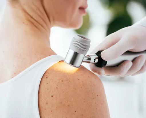 Dermatologist performing skin cancer screening with a dermatoscope to examine moles and skin lesions for early detection.