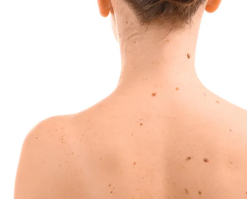Back with multiple moles and skin spots, illustrating dermatology mole evaluation, skin cancer screening, and lesion removal services.