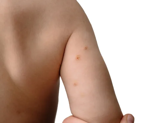 Close-up of a child's arm with skin lesions, possibly indicating chickenpox or a dermatological condition.