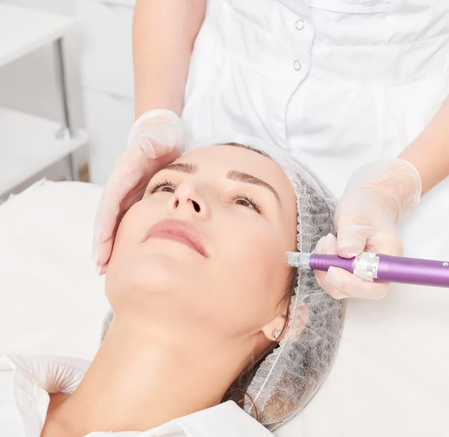 A woman undergoing microneedling treatment at a dermatology clinic for skin rejuvenation and collagen stimulation.