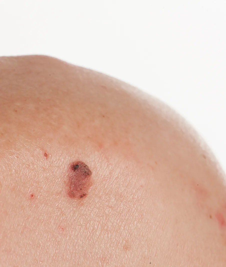 Close-up of skin showing irregular brown mole with surrounding red marks for dermatology assessment