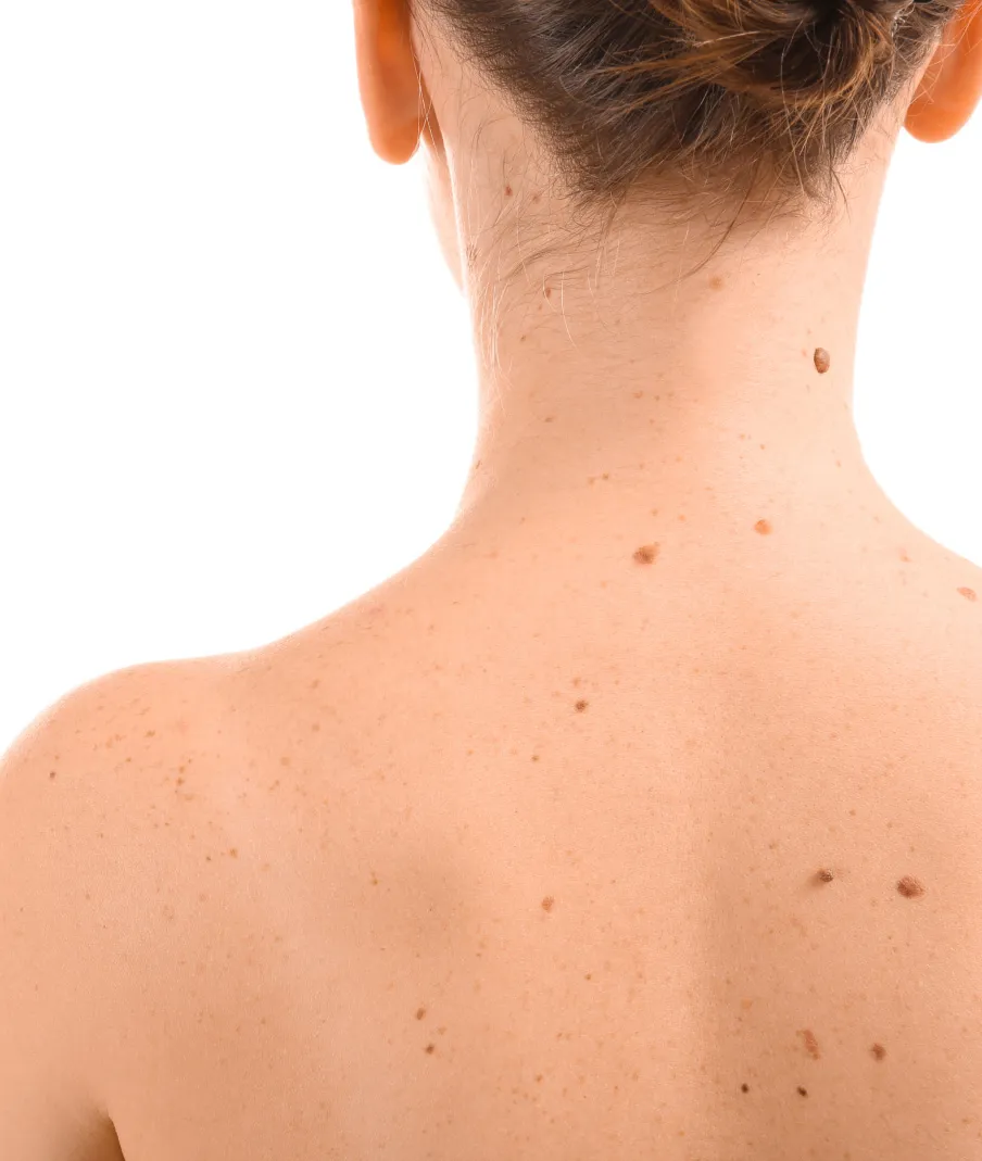 Back with multiple moles and freckles, requiring dermatology mole evaluation and skin cancer screening at a dermatology clinic.