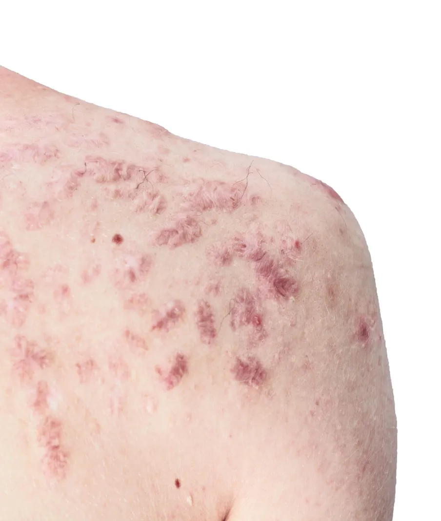 Close-up of woman's upper back showing raised keloid scar near shoulder