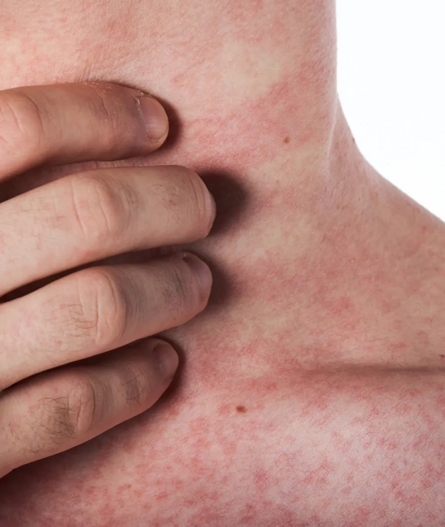 Red irritated skin on neck due to eczema or allergic reaction, treated by dermatologists for relief and skin health