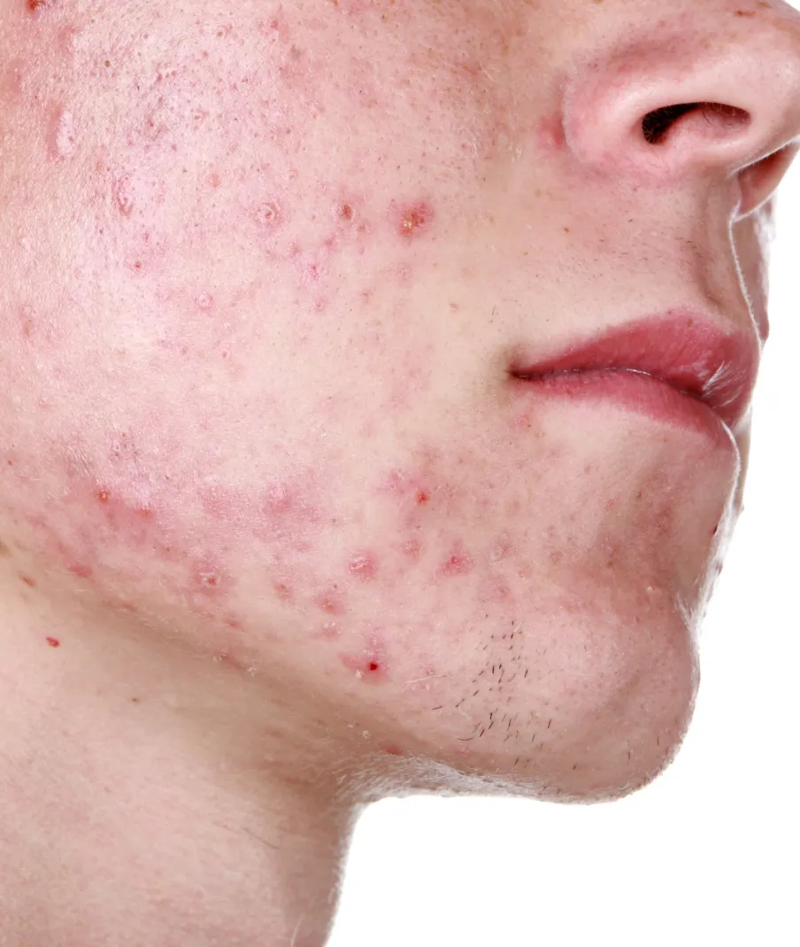 Close-up of lower face with moderate to severe acne showing inflamed pimples and pustules
