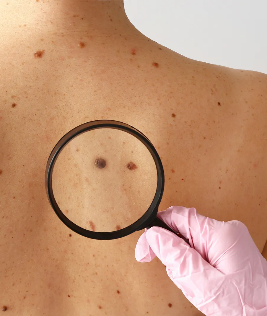 Dermatologist examining a large mole on person's back with magnifying glass