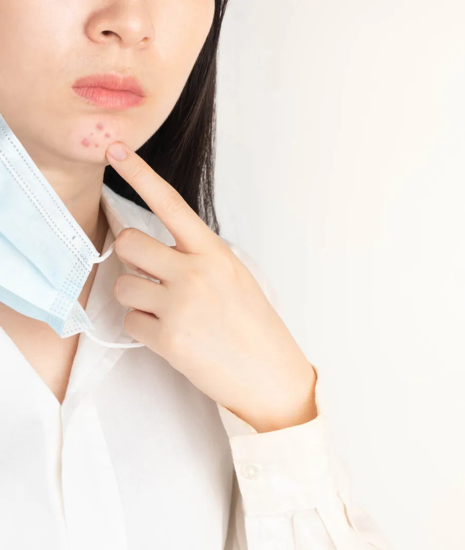 Woman pointing to acne on chin after wearing mask, highlighting skin irritation