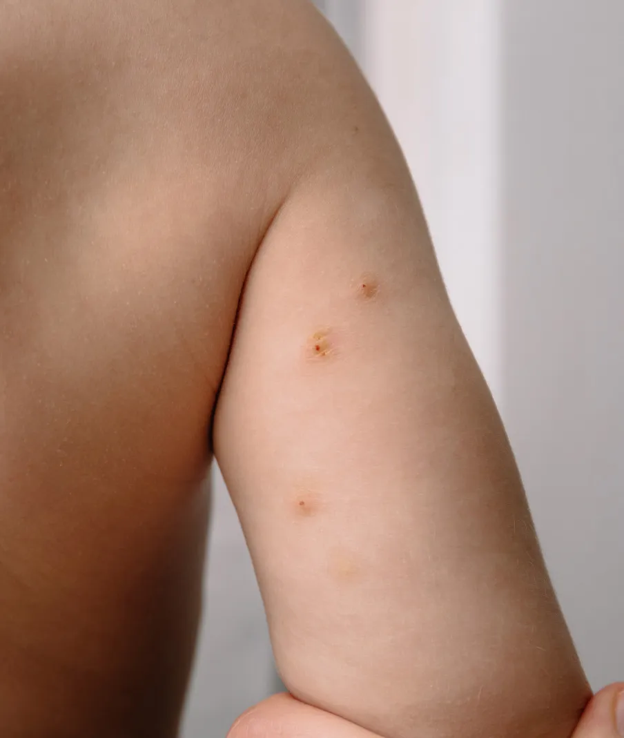 Close-up of skin with multiple flesh-colored Molluscum Contagiosum bumps caused by viral infection