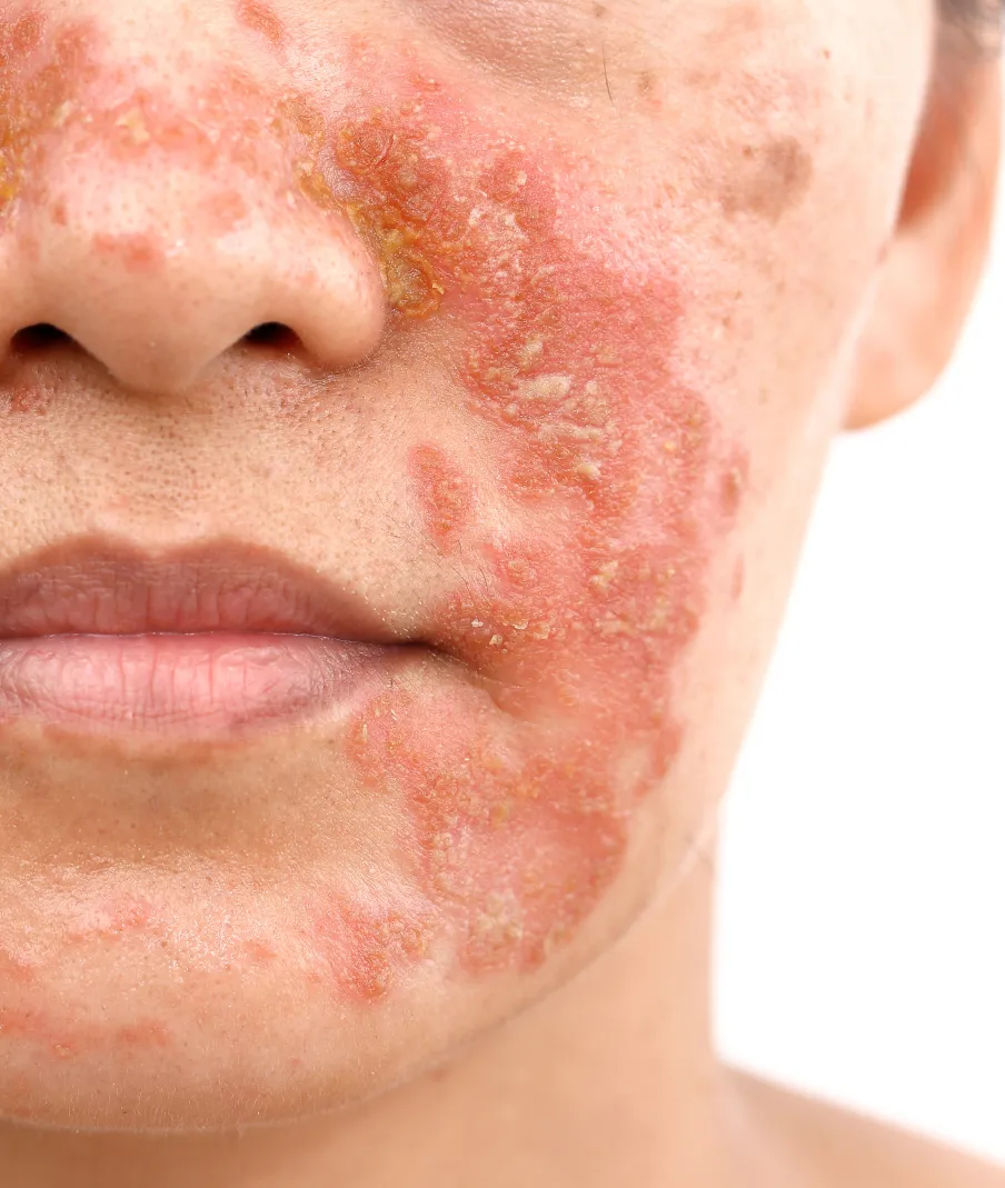 Severe facial dermatitis with redness and scaling, showcasing dermatology treatments for eczema, rosacea, and skin inflammation.