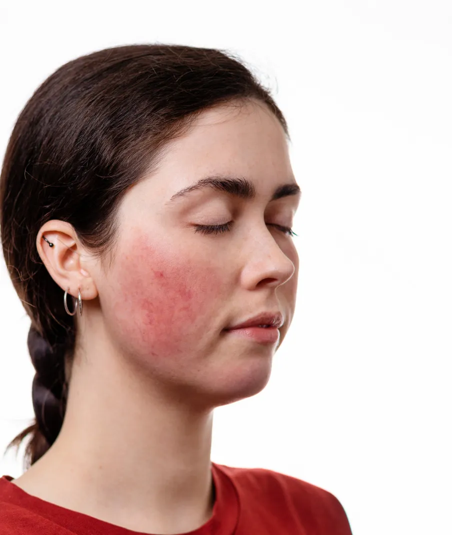 Woman with rosacea showing redness on cheek in close-up facial view