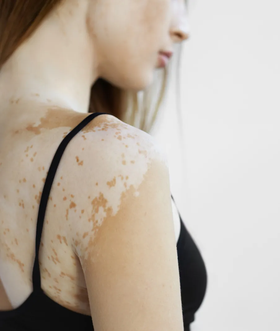 Woman with vitiligo on shoulder, highlighting dermatology treatments for pigmentation disorders and skin tone restoration.