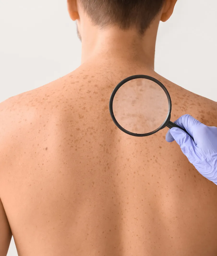 Dermatologist examining freckles and skin spots on a patient's back with a magnifying glass for skin health assessment.