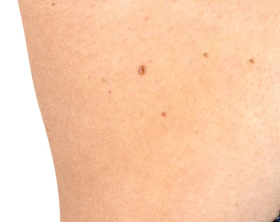 Close-up of healthy skin with multiple small moles and freckles for dermatology assessment