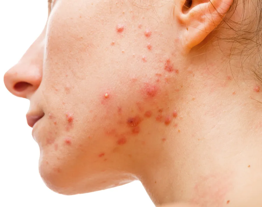 Acne treatment at a dermatology clinic. Expert care for reducing breakouts, inflammation, and acne scars for clearer skin.