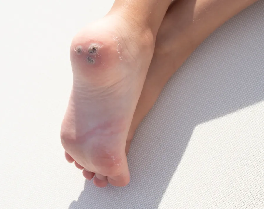 Plantar warts on foot caused by HPV, commonly treated by dermatologists with cryotherapy, laser, or topical treatments.