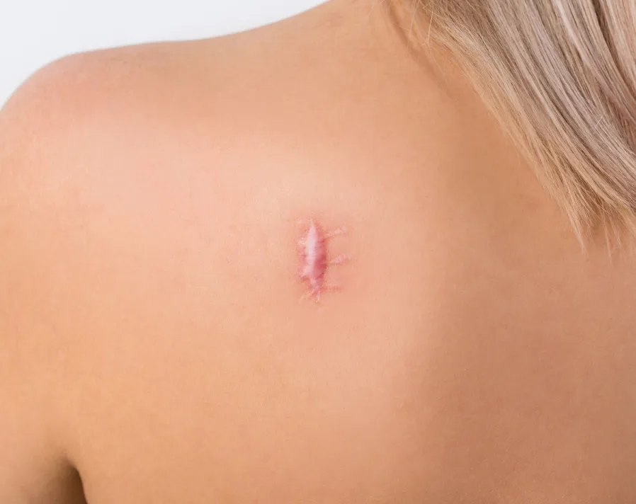 Close-up of shoulder showing raised, red keloid scars on inflamed skin