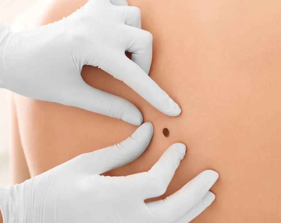 Dermatologist examining a mole for skin cancer detection and mole removal at a dermatology clinic.