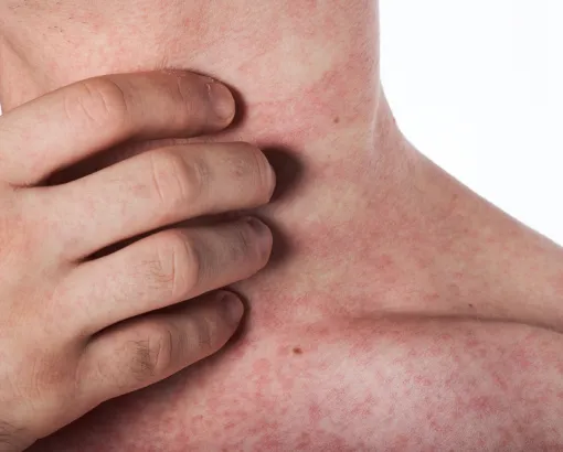 Close-up of irritated skin with redness and rash, indicating eczema or an allergic reaction.