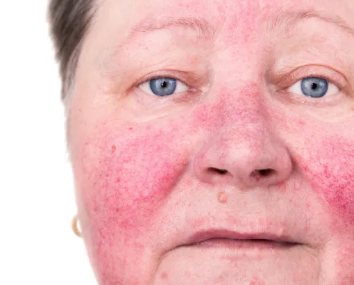 Close-up of an elderly woman's face with redness and inflammation, possibly indicating rosacea or a skin condition.