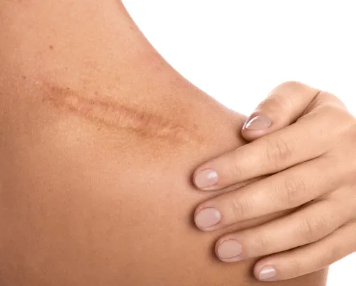 Close-up of a healed scar on a woman's shoulder, showcasing skin recovery and dermatology treatments.