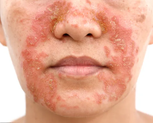 Close-up of a person's lower face with severe red, inflamed, and scaly skin around the nose, mouth, and cheeks, indicative of a dermatological condition.