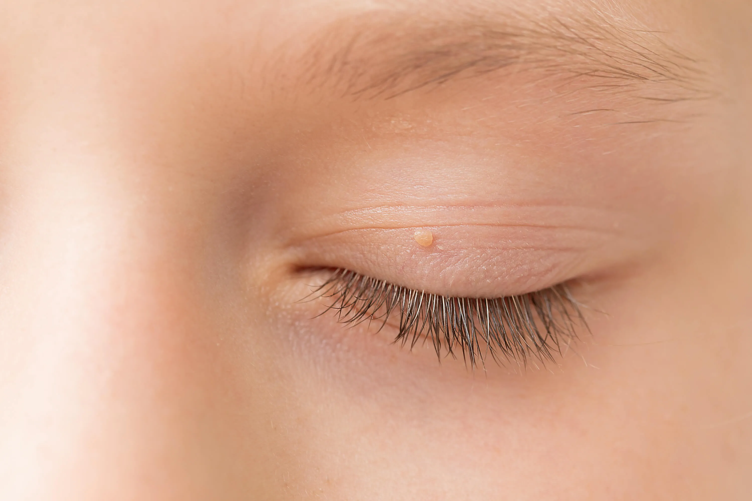 Close-up of an eyelid with a small skin-colored wart, possibly a molluscum contagiosum lesion, requiring dermatological evaluation.