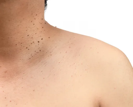 Skin tag and mole removal treatment for clear, healthy skin at a professional dermatology clinic.