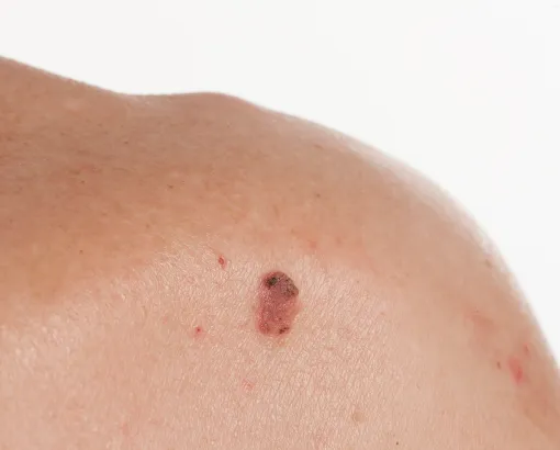 Close-up of a suspicious mole on a person's shoulder, potentially indicating skin cancer or abnormal growth.