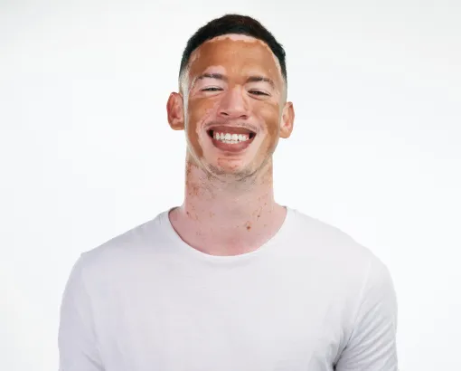 A smiling man with vitiligo wearing a white t-shirt, showcasing confidence and natural beauty.