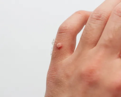 Close-up of a wart on a person's finger, possibly caused by the human papillomavirus (HPV).